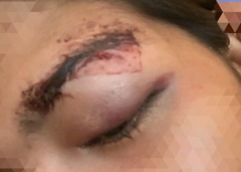 Pengusaha Hiburan Surabaya di laporkan Kasus Penganiayaan Berat Calon Terapis di Surabaya, Empat Bulan Tanpa Kejelasan