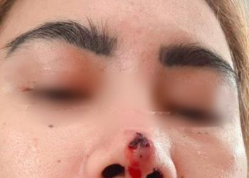 Elsa Korban Dugaan Malapraktik Klinik Dermakeys , Tuntut Tanggung Jawab dan Proses Hukum