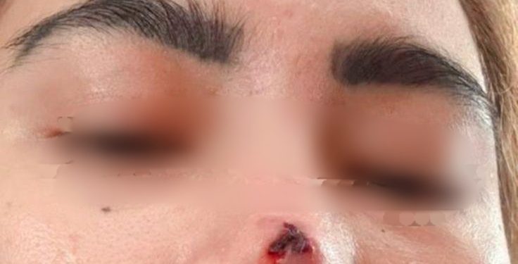 Elsa Korban Dugaan Malapraktik Klinik Dermakeys , Tuntut Tanggung Jawab dan Proses Hukum