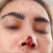Elsa Korban Dugaan Malapraktik Klinik Dermakeys , Tuntut Tanggung Jawab dan Proses Hukum
