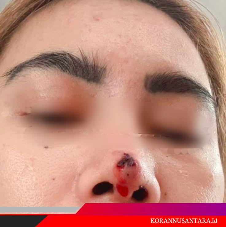 Elsa Korban Dugaan Malapraktik Klinik Dermakeys , Tuntut Tanggung Jawab dan Proses Hukum