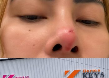Owner Sebut Ditangani Dokter Umum, Mediasi Kasus Dugaan Malapraktik Klinik Dermakeys Berujung Buntu